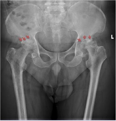 Septic arthritis with osteomyelitis due to Salmonella enterica serotype Dublin: A case series